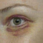 black eye
